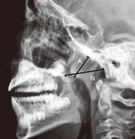 Method Of Assessing Adenoid Enlargement On Lateral Neck Open I