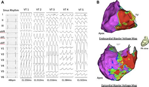 A Twelve Lead Electrocardiogram During Sinus Rhythm And The