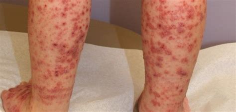 Idiopathic Thrombocytopenic Purpura Rash