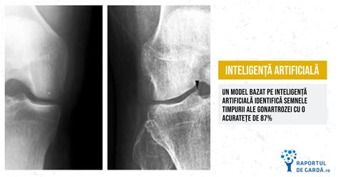 Studiu Gonartroza Identificat Precoce De Un Algoritm Ai Care