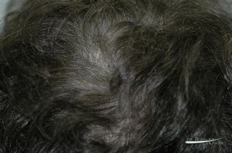 Treatment to hair thinning in the vertex | Dr. Unger | Dr. Robin Unger ...