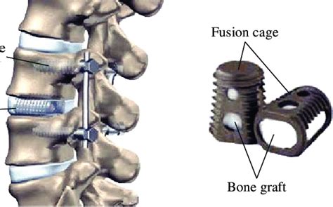 Posterior Lumbar Fusion