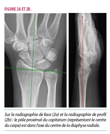 Prise En Charge Dune Fracture Du Radius Distal Chez Ladulte Le Bon