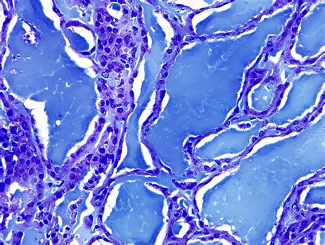 Thyroid Cancer Adenocarcinoma Light Micrograph Stock Image C