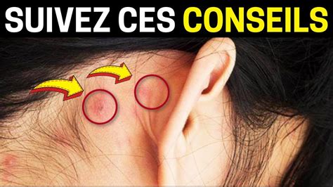 Boutons Derri Re L Oreille Les Meilleurs Conseils De Pr Vention Youtube