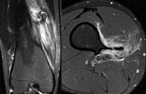 Osteochondroma Femur