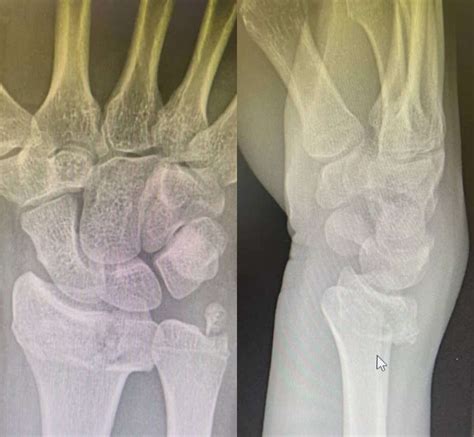 Wrist Fracture Surgery | London & Kent