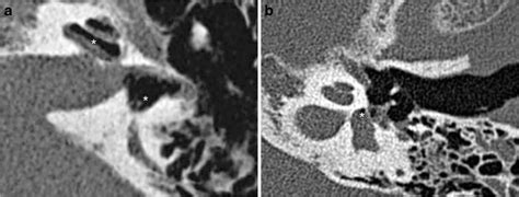 A Perilymphatic Fistulae Ct Axial Views Showing A Perilymphatic