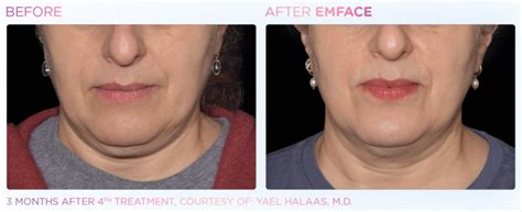 EmFace Facial Contouring Without Surgery Or Needles