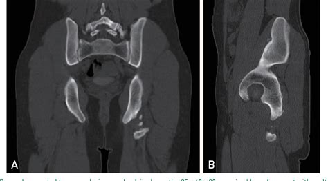 Figure 1 From Ischial Tuberosity Avulsion Stress Fracture After Short