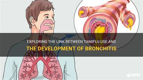 Exploring The Link Between Tamiflu Use And The Development Of Bronchitis Medshun