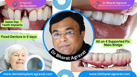 Best Dentist For Full Mouth Dental Implants Clinic In Ahmedabad Dr