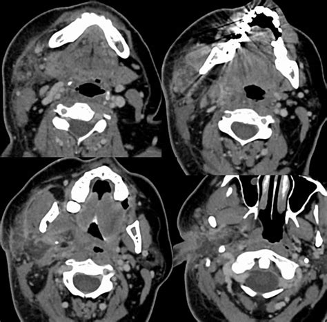 Acute Parotitis