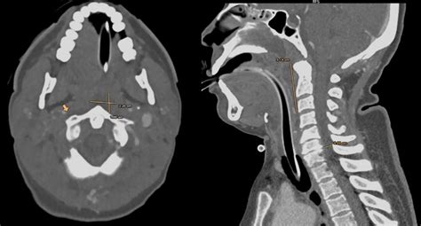 CT images demonstrating initial retropharyngeal abscess measuring ...