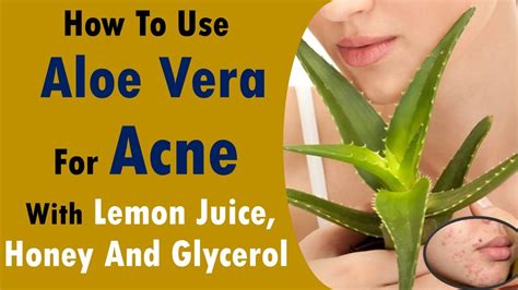 How To Use Aloe Vera For Acne With Lemon Juice Honey And Glycerol