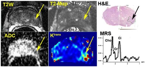 An Example Of Multiparametric Imaging Of Prostate Top Row T2 Weighted