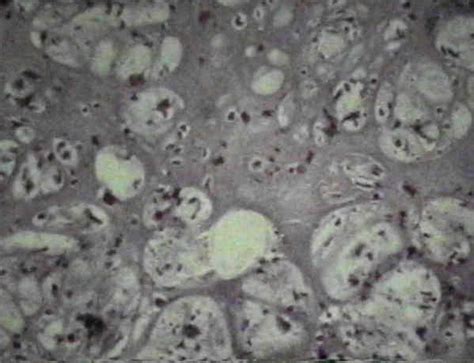 Histology of Chondrosarcoma : Wheeless' Textbook of Orthopaedics