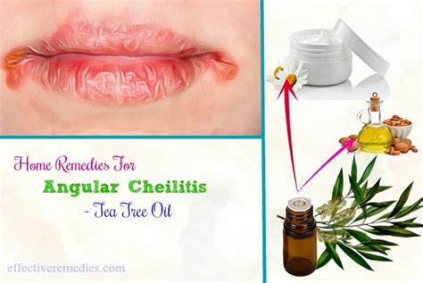 20 Home Remedies For Angular Cheilitis Cracks In Mouth Corners