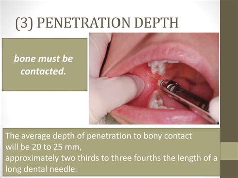 Mandibular Anesthesia Inferior Alveolar Nerve Block Ppt