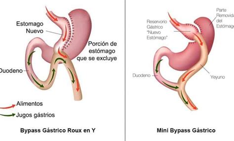 Descripción General Del Mini Bypass Gástrico Cirugía Estética