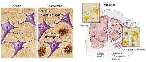 ¿qué Es La Enfermedad De Alzheimer Lola Alzheimer