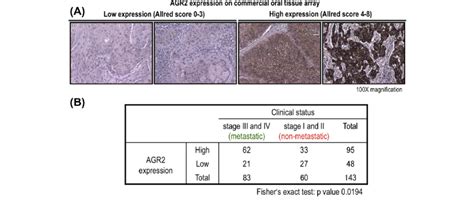 High Expression Of AGR2 Is Clinically Correlated With Metastatic