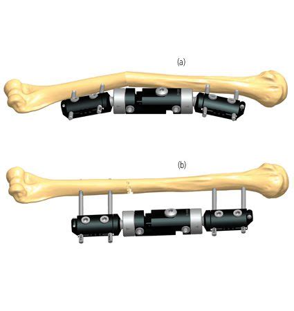 Humerus Deformity Treatments Orthofix Abs