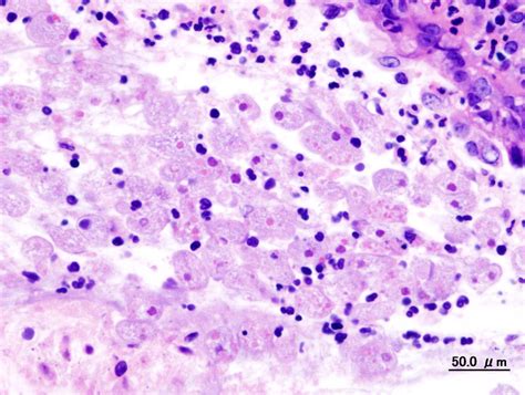 Amoebic infections | eNetMD