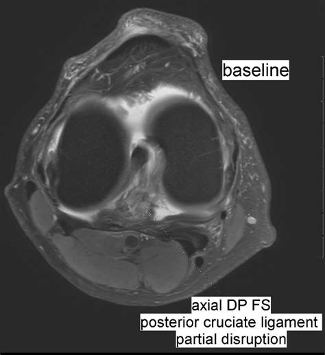 Benoît Rizk On Twitter Posterior Cruciate Ligament Tear After Bike Fall Conservative