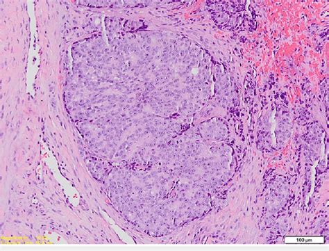 Photomicrograph Shows A Tumour Island Consisting Of Central Round Cells