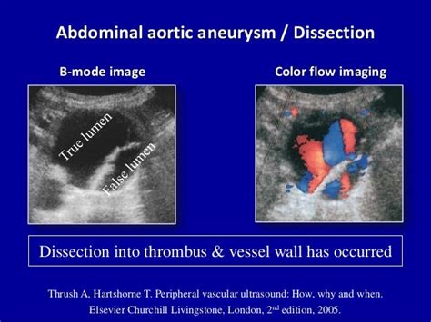 Dissecting Aneurysm Ultrasound