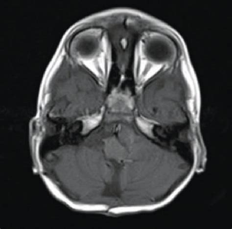 A Coronal T2 WI B C Axial T2 WI D E Axial T1 WI F G Axial