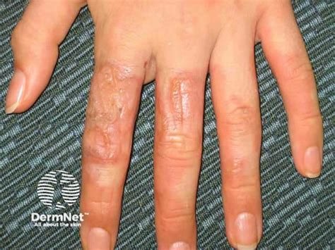 Photocontact Dermatitis Causes Symptoms Diagnosis Treatment
