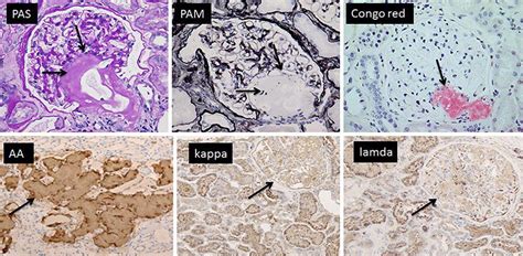 Renal Biopsy Amorphous Deposits Arrows By Periodic Acid Schiff Pas Download Scientific