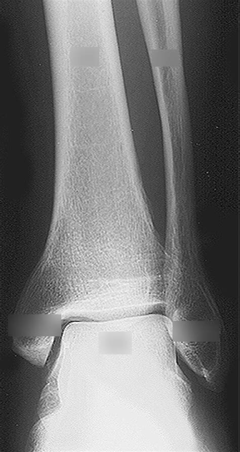 Ankle Talocrural Joint Ap Xray Diagram Quizlet