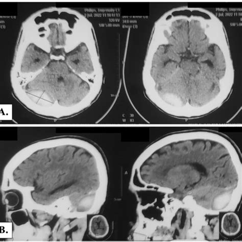 Head Ct Scan Examination A Axial Section And B Sagittal Section Download Scientific Diagram