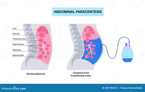 Abdominal Paracentesis Poster Stock Vector Illustration Of Abdomen