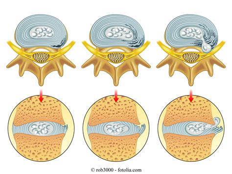 Symptome Bei Bandscheibenvorfall Erkennung Schmerzen Symptome
