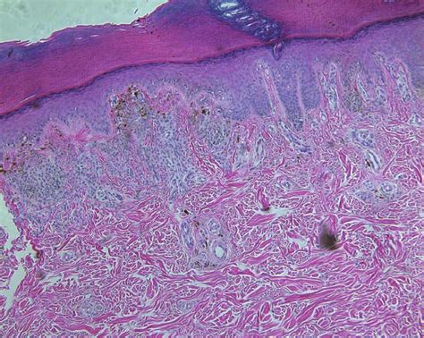 Numerous Nests And Clumps Of Melanocytic Nevus Cells In The Upper