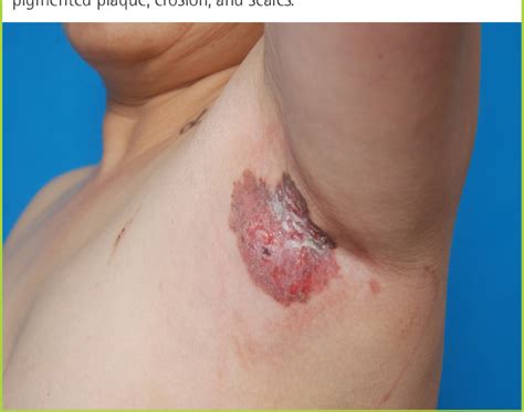 Figure From Co Occurrence Of Apocrine Adenocarcinoma And Invasive