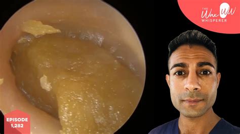 Very Impacted Ear Wax Removal Youtube