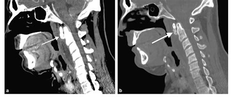 Figure From Calcific Retropharyngeal Tendinitis Of The Longus Colli