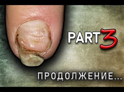 УЖАСНЫЙ МАНИКЮР😱ГНОЙНОЕ Воспаление Кутикулы после Маникюра.Часть 3 ...