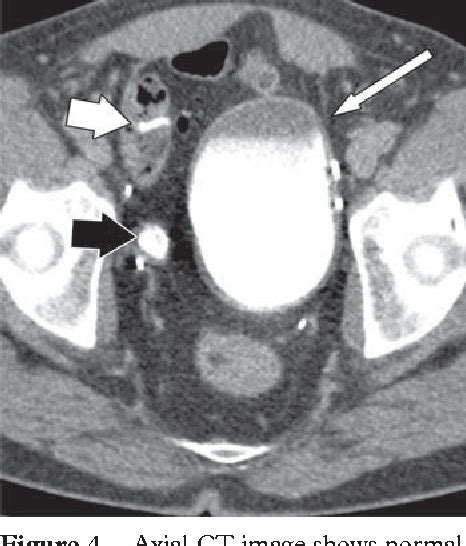 Figure From Ct Findings In Urinary Diversion After Radical Cystectomy