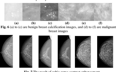 [PDF] The Classification of Breast Calcification using Texture Feature ...