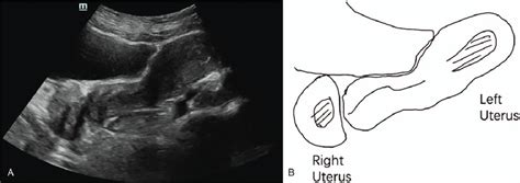 Two Dimensional Transabdominal Ultrasonography Showing The Longitudinal