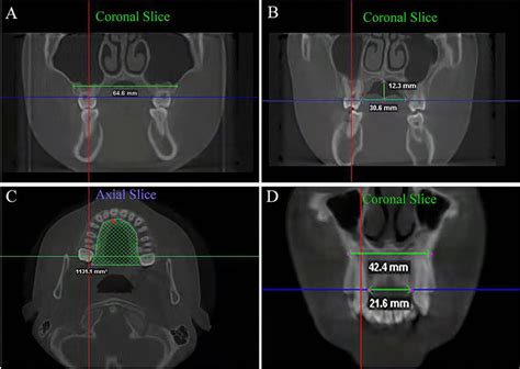 Schematic Diagrams Of Maxillary Arch Measurements A Mwm B Imw And Ph