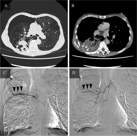 Bronchial Artery Embolization For Haemothorax And Haemoptysis Caused By