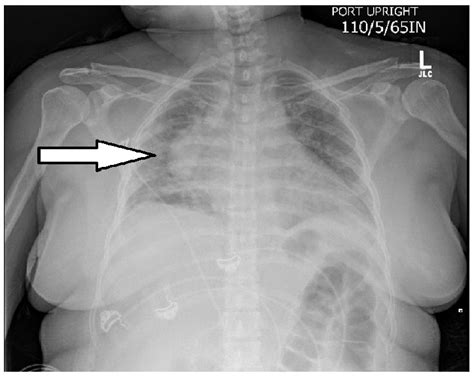 Chest X Ray Showing Right Posterior Mediastinal Mass Suggestive Of A