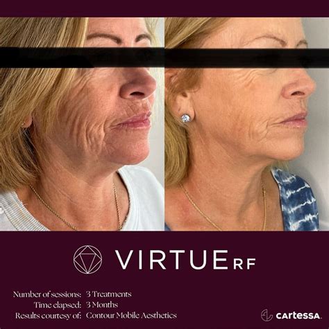 Virtue Rf Microneedling Indianapolis In Skin Renew Day Spa Laser